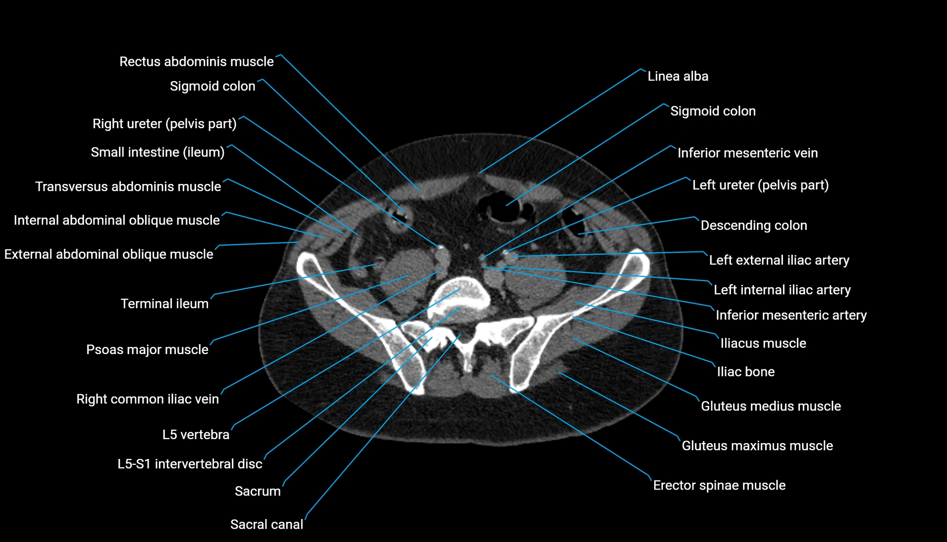 CT urogram axial cross sectional anatomy  labelled radiology image-00176.webp